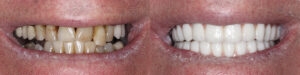 Full smile after All-on-4 implants — patient JM