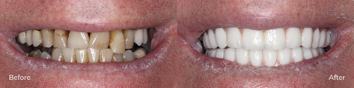 Full smile after All-on-4 implants — patient JM